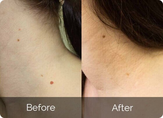 Skinfinity Skin Tag Remover-reviews