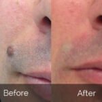 Skinfinity Skin Tag Remover-real-reviews